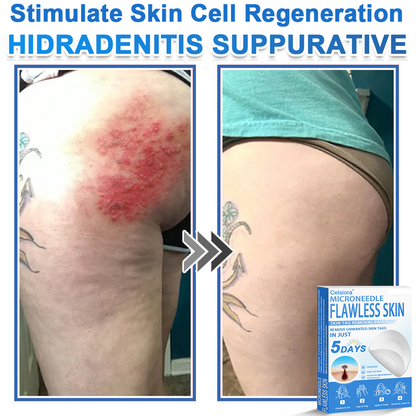 ⭐ Celsiora® 2-in-1 Microneedle & Hydrocolloid Patch | Raised Moles,Acne,  Flat Warts & Skin Tags Remover | Improves Wrinkles, Scars & Blemishes | Invisible Pimple Patches for Face & Body