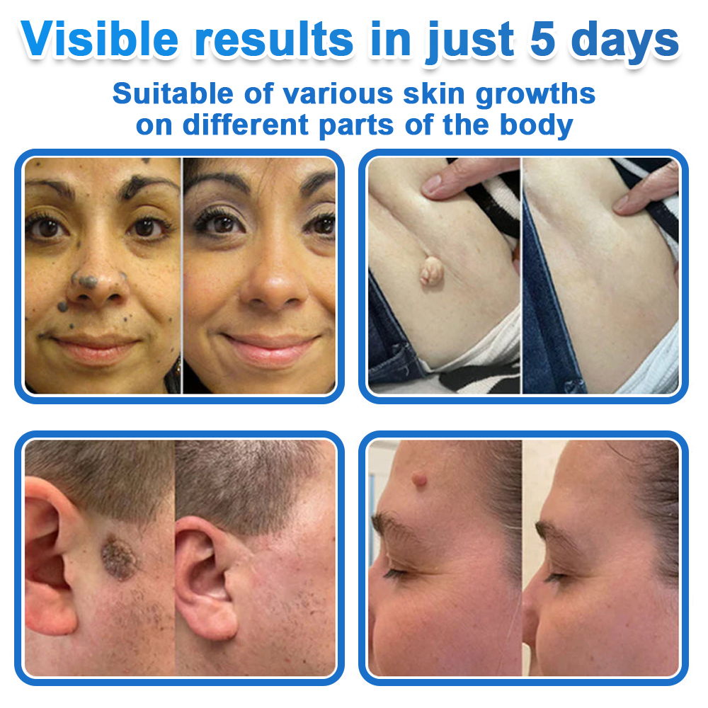 ⭐ Celsiora® 2-in-1 Microneedle & Hydrocolloid Patch | Raised Moles,Acne,  Flat Warts & Skin Tags Remover | Improves Wrinkles, Scars & Blemishes | Invisible Pimple Patches for Face & Body