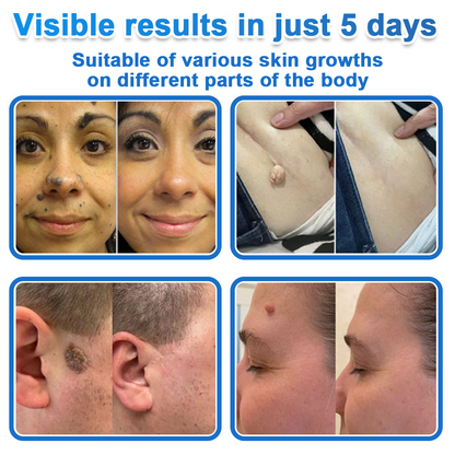 ⭐ Celsiora® 2-in-1 Microneedle & Hydrocolloid Patch | Raised Moles,Acne,  Flat Warts & Skin Tags Remover | Improves Wrinkles, Scars & Blemishes | Invisible Pimple Patches for Face & Body